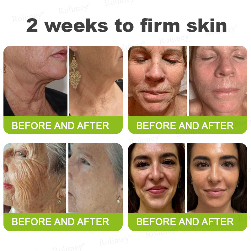 ☘️💎Made and shipped from Australia 💫Rolimey® Botox & Vita-A Retinol Shot Wrinkle-Lift Tightening cream - Last Day Promotion 70% OFF
