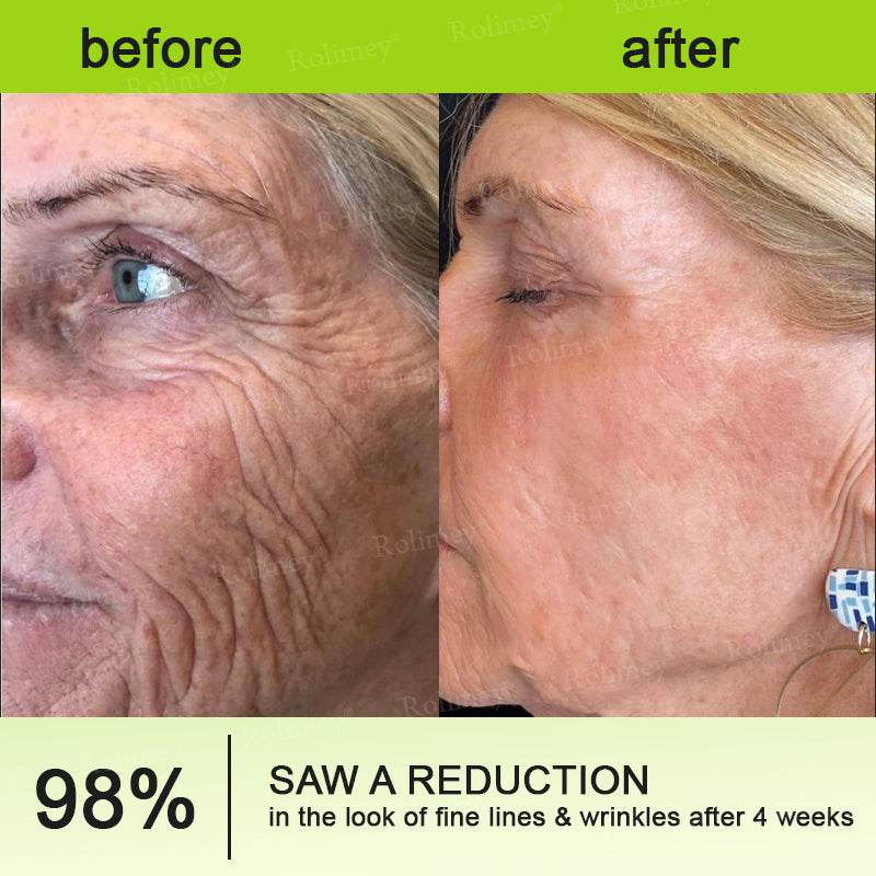 ☘️💎Made and shipped from Australia 💫Rolimey® Botox & Vita-A Retinol Shot Wrinkle-Lift Tightening cream - Last Day Promotion 70% OFF